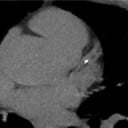 Heart CT calcium scoring (with low-dose radiation)