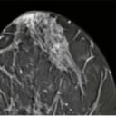 Mamma MRI (with contrast dye)