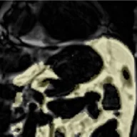 Graisse viscérale : les risques cachés de la graisse abdominale et comment la réduire